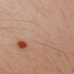Detailed close-up image of a mole on human skin, ideal for dermatology topics.