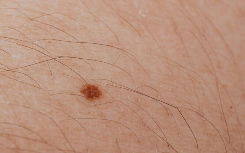 Detailed close-up image of a mole on human skin, ideal for dermatology topics.